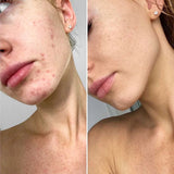 Alpha-H 祛痘除印啫喱 20ml